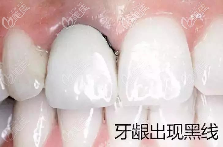 烤瓷牙牙龈发黑现象