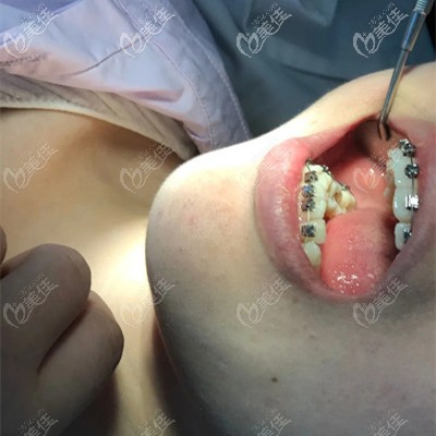 拔牙托槽矫正牙齿的过程