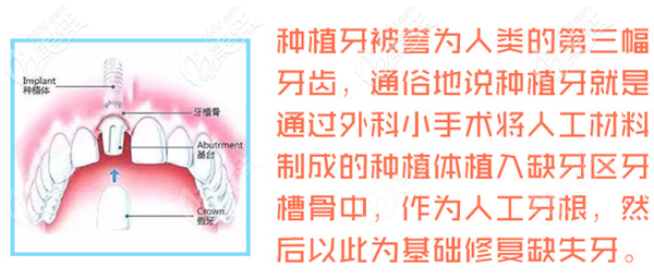 种植牙的优势 种植牙的优势