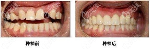 福州登特口腔做韩国登腾即刻种植牙案例 福州登特口腔做韩国登腾即刻种植牙案例