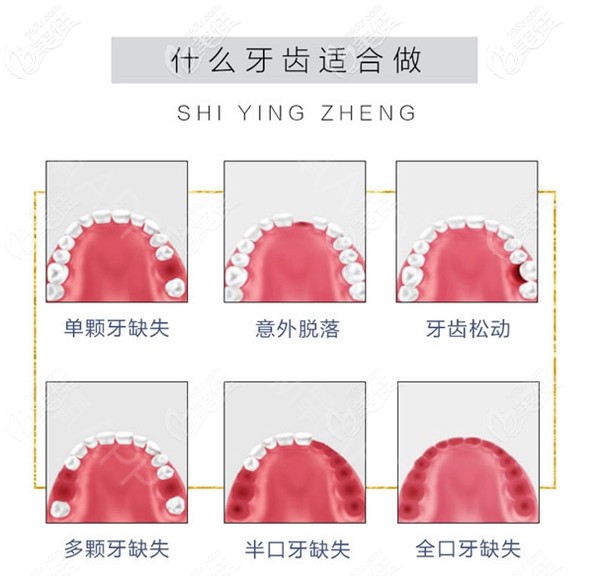 什么牙齿适合做种植牙