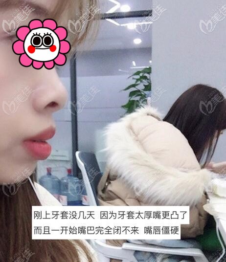 杭州齐尔口腔做金属自锁牙套