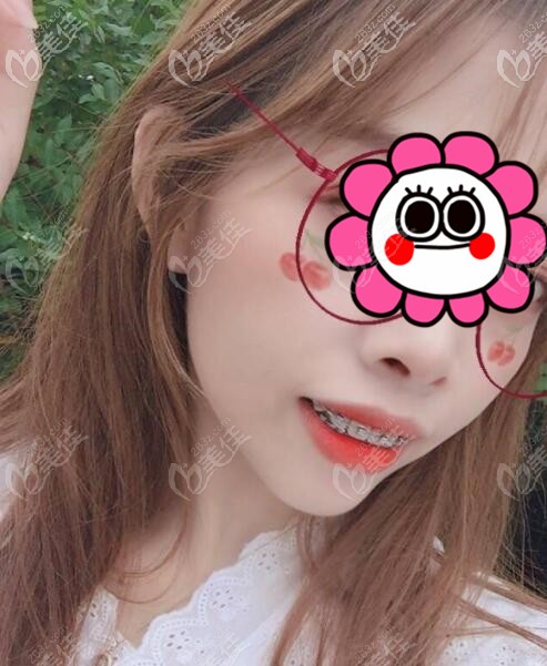 金属自锁牙套矫正过程中