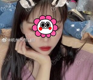 杭州齐尔口腔吴叶群金属自锁矫正效果