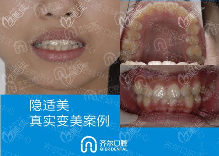 杭州齐尔口腔隐适美矫正前