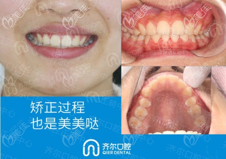 杭州齐尔口腔隐适美矫正案例