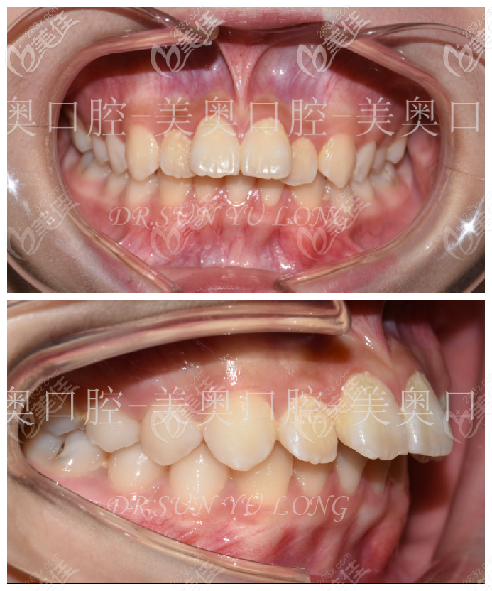 13岁的小豪替牙期出现牙齿前突,影响美观 13岁的小豪替牙期出现牙齿前突,影响美观