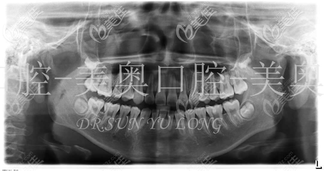 做牙齿矫正术前的全景片 做牙齿矫正术前的全景片