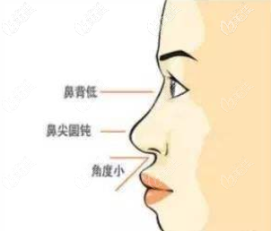 鼻行不佳示意图 鼻行不佳示意图