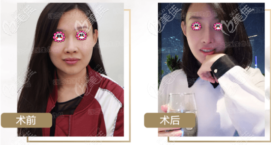 北京俏中关医美膨体鼻综合案例 北京俏中关医美膨体鼻综合案例