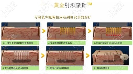 黄金射频微针治疗原理过程示意图 黄金射频微针治疗原理过程示意图