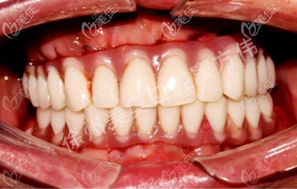 种植牙牙龈瓷效果图图片