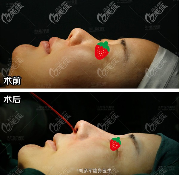 刘彦军挛缩鼻修复案例