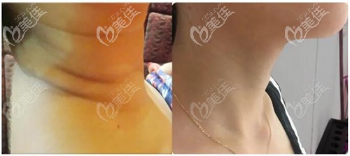 小针自体修复颈纹案例