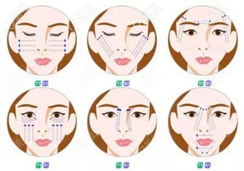 埋线提升的好处