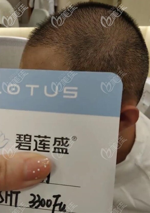SHT植发3300毛囊单位术后2个月效果