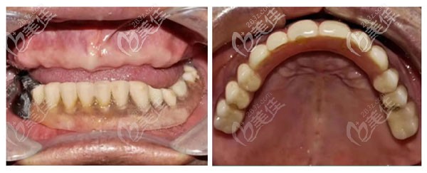 昆明柏德口腔做半口种植牙的案例效果对比图