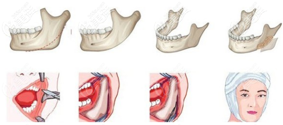 下颌角手术的切口位置