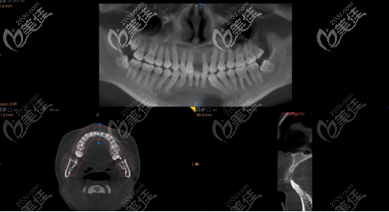 术前拍摄的ct 术前拍摄的ct