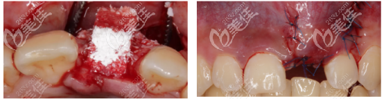 植入骨粉的样子 植入骨粉的样子