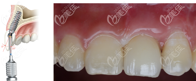 用纯钛基台+植入骨粉种植上门牙，半年后未出现骨吸收现象