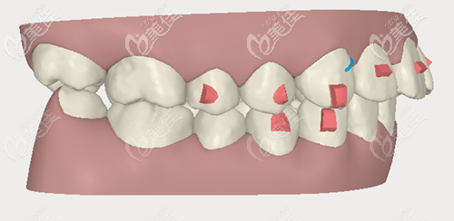 隐适美矫正凸嘴 隐适美矫正凸嘴