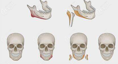 下颌角手术示意图