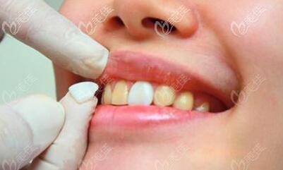 牙齿贴面有哪几种材料，选择哪种比较好呢