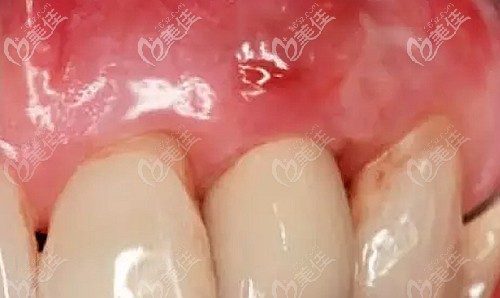 种植牙后牙龈上出现瘘管的原因