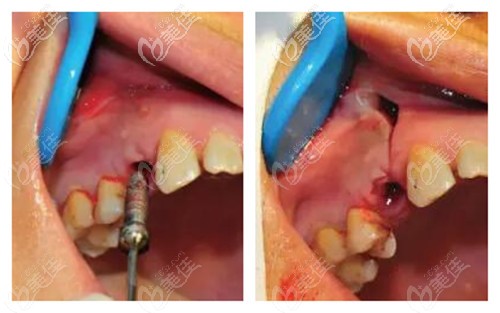 牙龈瘘管的解决方法