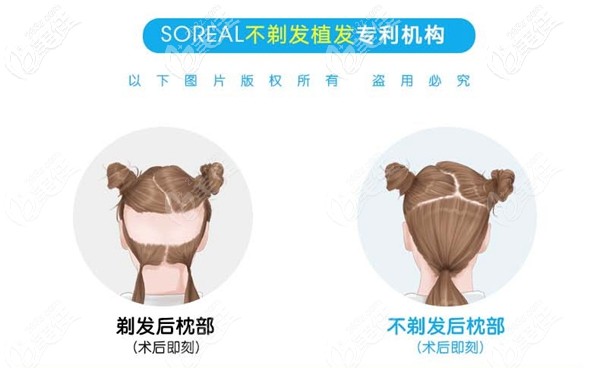 首瑞不剃发种植专属机构 首瑞不剃发种植专属机构