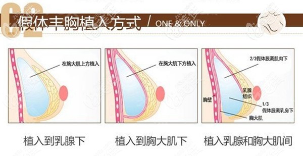 壹加壹曼托假体隆胸植入方式 壹加壹曼托假体隆胸植入方式