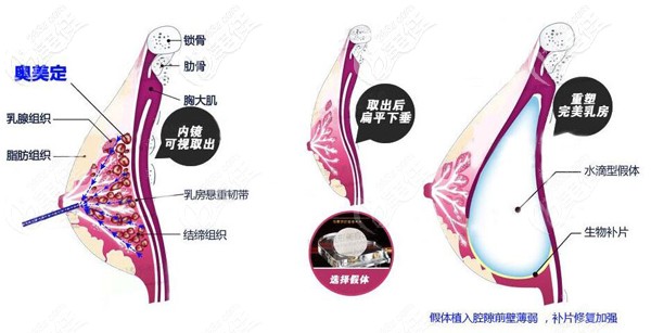 奥美定取出后要定制版3D智能基因生物补片修补缺损部位