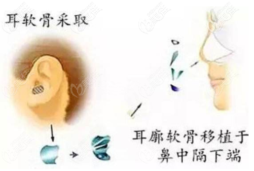 取耳软骨的部位