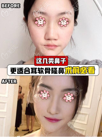 双侧耳软骨隆鼻效果图