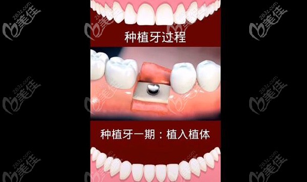 种植牙一期手术