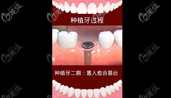 种植牙二期手术