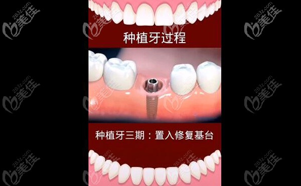 种植牙三期手术