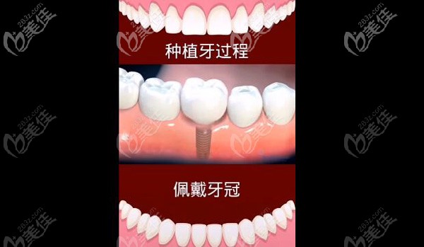 种植牙三期术后佩戴牙冠