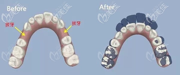 矫正牙齿前必要时还得拔牙 矫正牙齿前必要时还得拔牙