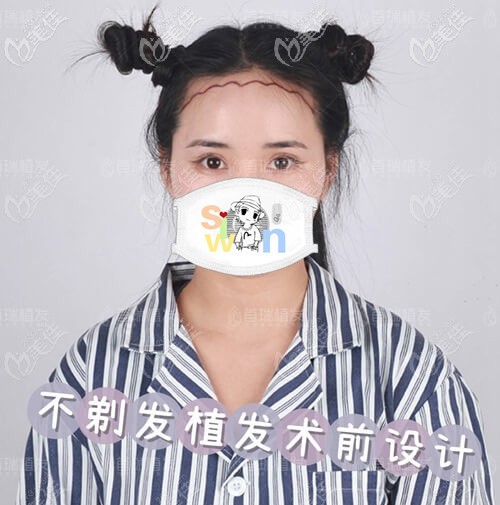 首瑞不剃发植发术前设计 首瑞不剃发植发术前设计