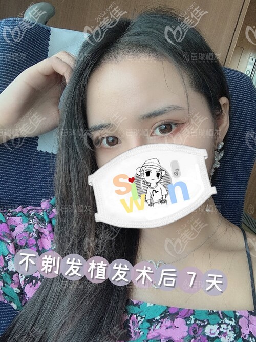 首瑞不剃发植发术后7天 首瑞不剃发植发术后7天