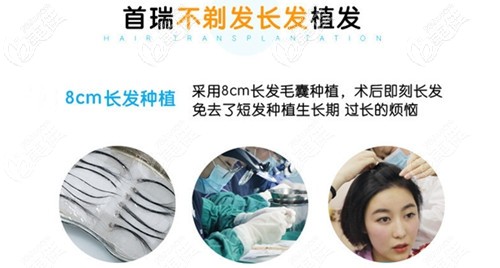 首瑞的不剃发长发植发技术 首瑞的不剃发长发植发技术
