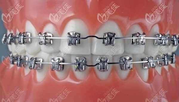 金属托槽矫正牙齿的效果