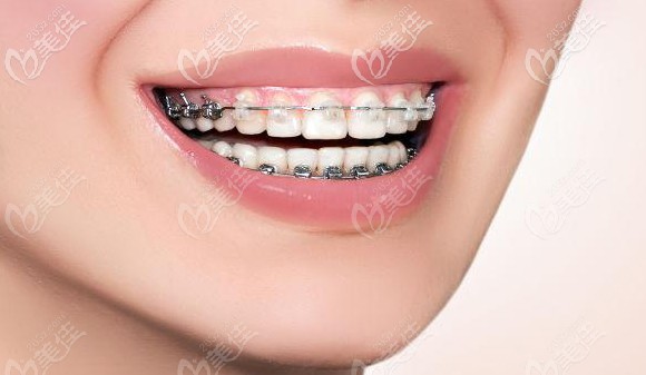 番禺区三仁口腔的正畸特价项目 番禺区三仁口腔的正畸特价项目