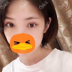 在福州格莱美做全切双眼皮术后7天