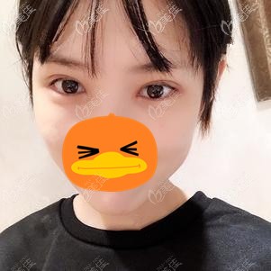 在福州格莱美做全切双眼皮术后2周