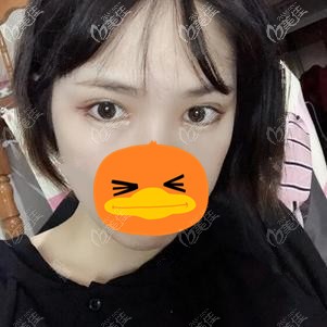 在福州格莱美做全切双眼皮术后1个月