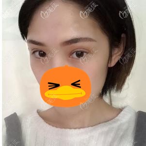 在福州格莱美做全切双眼皮术后2个月