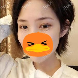 在福州格莱美做全切双眼皮术后3个月